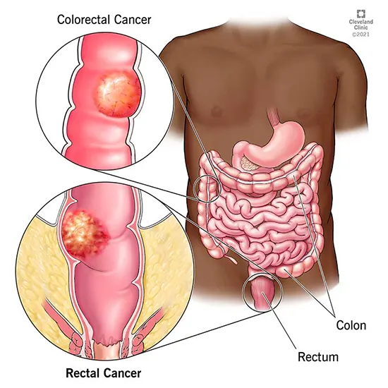 colorectal cancer package test
